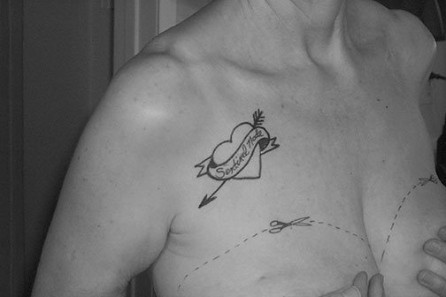 Surgery Site as marked by Danielle